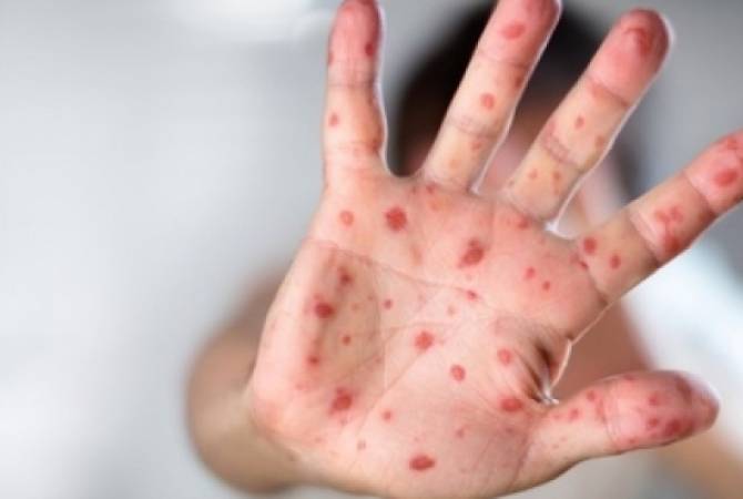 Measles cases in the US have reached their highest level since 1991
