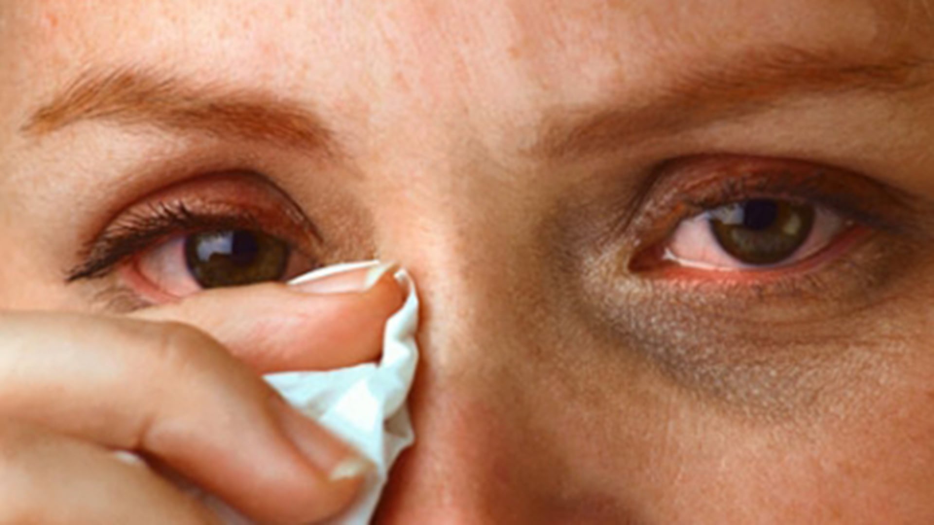 Արցունքահոսություն